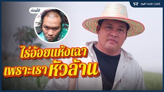 EP8: คงหัวล้านไปจนตาย เปิดใจอดีตหนุ่มหัวล้าน ที่เปลี่ยนชีวิตไปแล้ว HERRMETTO หัวล้าน แก้ได้