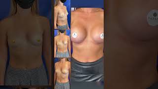 Breast Augmentation Results Review with Dr. Farber - 3.5 Months into Recovery