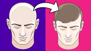 Top 5 Hair Loss Solutions That Actually Work | Surgeon Reacts