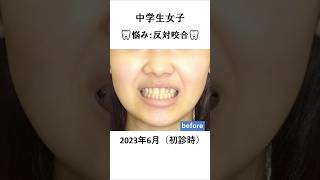 反対咬合の矯正治療例 #歯医者 #矯正歯科 #orthodontics