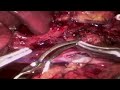 laparoscopic major venous resection during pancreaticoduodenectomy