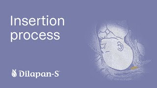 Insertion process of DILAPAN-S step by step