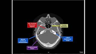 How to read Brain Bone window study with voice