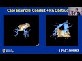 Transcatheter pulmonary valve replacement in adults with congenital heart disease Dr. Goldstein, MD