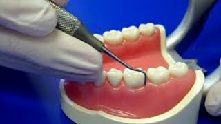 Posterior Dental Scaling video, 204S, BH5/6