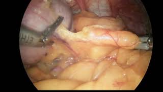 Sleeve Gastrectomy, Dr. Treen sclaweightloss.com