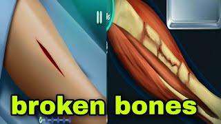 (ASMR) Broken Bones surgery and operation India (Animation )(3D view)#asmr#animation#surgery