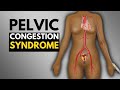 What Is Pelvic Congestion Syndrome?