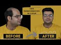 Non surgical Hair Replacement | Hair Patch | Full Review | Hair Wig house | 9953384242