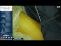 watch live surgery left ulnar nerve decompression at elbow