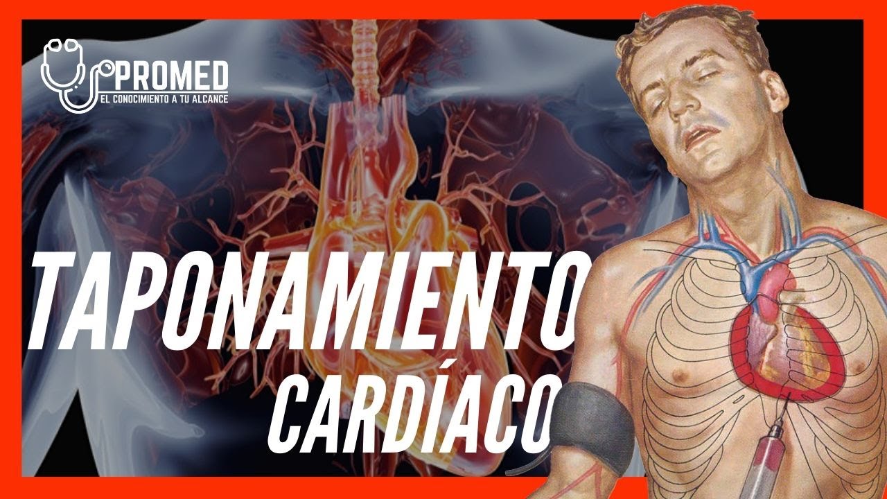 😱Taponamiento Cardíaco 🤓 ¡EXPLICACIÓN! Definición, Fisiopatología ...