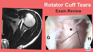 Rotator Cuff Tears Exam Review - William N. Levine, MD