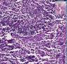 Histopathology Lung --Aspergillosis