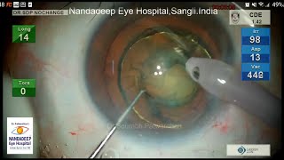 Nucleus lift technique Legion phaco parameters Dr Sourabh Patwardhan Live Cataract surgery