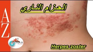 H. zoster | Shingles | Chickenpox | Fro A to Z| الحزام الناري| الهربيس العصبي | فاريسيلا زوستر