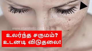 உலர்ந்த சருமம்? உடனடி விடுதலை! | How to remove Dry Skin from Face