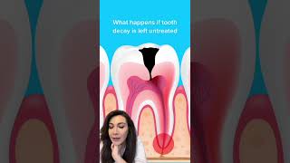 How Do You Get Dental Cavity?!