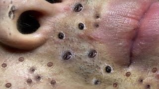 Loan Nguyen Acne Treatment 52x