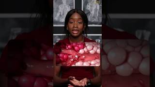Sickle Cell Anaemia Explained and Simplified!