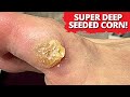 Bunion Causes DEEP SEEDED CORN Removal! *Satisfying Foot Care*