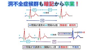 心電図：暗記からの卒業 78話 洞不全症候群