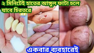 এক রাতেই হাতের আঙ্গুল ফাটা দূর করার ঘরোয়া উপায় ১০০% 😱 cracked