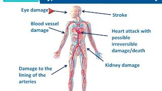 Managing Hypertension: Heart Forum Webinar | CardioSmart