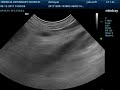 Small Animal Ultrasound - Adrenal mass - Pheochromocytoma