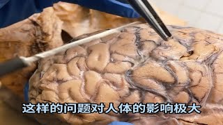 非常清晰的脑血管标本