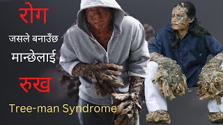 Tree-man Syndrome || एउटा एस्तो रोग जसले मान्छेलाई रुख बनाइदिन्छ