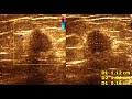 Breast Carcinoma | Fibroadenoma Breast | Benign Vs Malignant Breast Masses