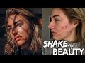 Severe Acne Made Me Feel Unworthy Of Love | SHAKE MY BEAUTY