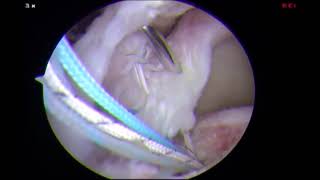 Revision Rotator Cuff Repair A Comprehensive Approach and Stepwise Technique
