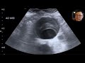 Abdominal Aortic Aneurysm - How to use Point of Care Ultrasound to detect it?