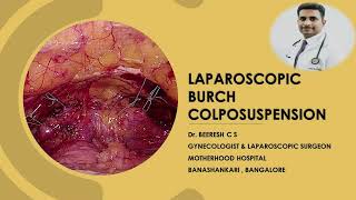 Burch Colposuspension- Non mesh approach for Urinary Stress Incontinence