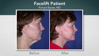 How to Insure Invisible Facelift Scars