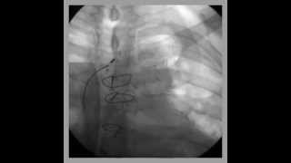 Video 60.12 - Interventional Cardiac Electrophysiology