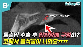 [닥터봉TV_CBK성형외과_최봉균] 돌출입 수술 후 입천장에 구멍이? 코에서 음식물이 나와요ㅠㅠ[CBK整形外科_チェ·ボンギュン] 突出口手術後、口の天井に穴が？ 鼻から食べ物が出ますㅠㅠ