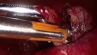 Laparascopic chocolate cyst excision | ARC Fertility India | Ovarian cysts