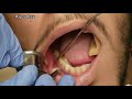 more dental abscesses watson explores abscesses