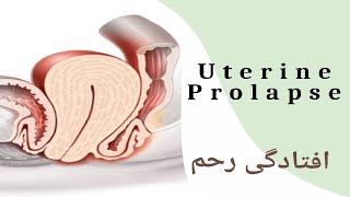 افتادگی رحم : هر آن چیز مهمی که هر خانم و هر فرد راجی به رحم خود باید بداند