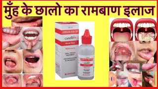 Candid Gel for mouth ulcer | Treatment of Mouth ulcer | Medical knowledge | Medicine Information