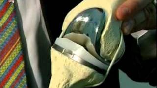 Knee: Minimally Invasive Total Knee Replacement Surgery Part 1