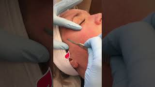 Dermaplaning- Better Than Shaving Your Face? #shorts #dermaplaning