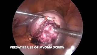 lap myomectomy \u0026 power morcellation