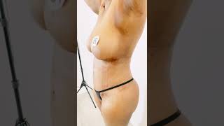 BodyLift and Transverse upper bra line lift with Breast Lift and Arm liposuction with Bodytite