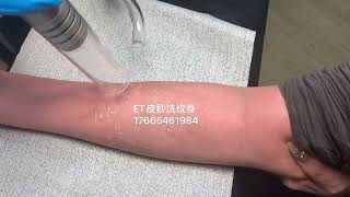 美國賽諾秀皮秒洗紋身過程。tattooremovalq#tattooremover #洗紋身#香港洗紋身#深圳洗紋身#皮秒洗紋身#洗纹身#激光洗紋身#tattoo#祛斑#洗纹身#澳門洗紋身#洗眉