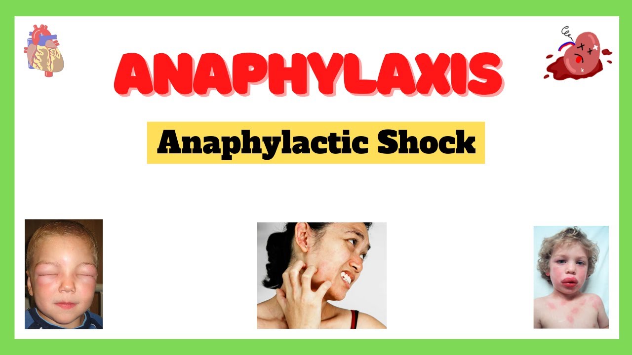 Anaphylactic Shock (Anaphylaxis)| Signs And Symptoms, Causes ...