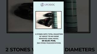 Kidney Stone Case Study: Percutaneous Nephrolithonomy (PCNL)