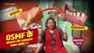 OSMF के साधारण और असाधारण लक्षण जानिए || Normal and Abnormal symptoms of OSMF ?